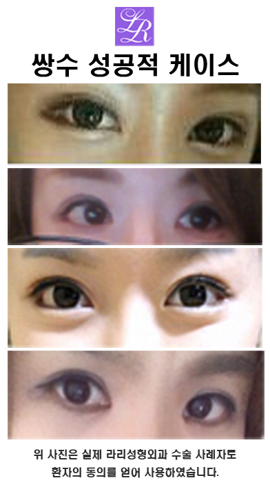 About the Appropriate Height of Double-Eyelid Lines image 1