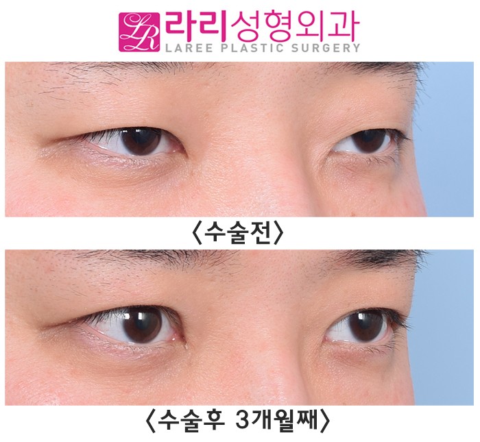 [Lari Plastic Surgery] Before and After Incisional Ptosis Correction Surgery for a Soft Impression Without Feeling Overdone image 2