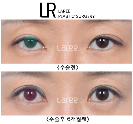 [Lari Plastic Surgery] The Real Way to Make Eyes Bigger: Eyelid Correction Surgery Is Needed Before Canthoplasty. image 2