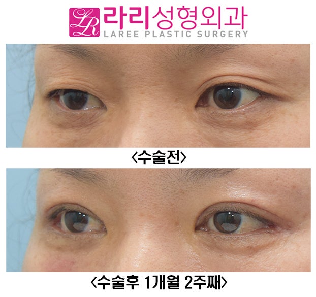 [라리성형외과] 자연스러운 절개눈매교정과 함께한 눈꼬리내리기뒤트임 수술전후 관련 이미지 6
