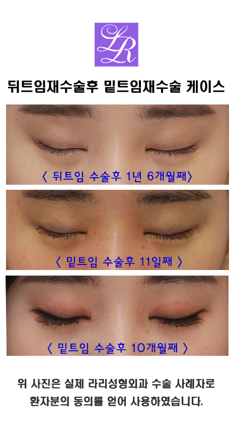 뒤트임재수술 하고나서 밑트임재수술 가능할까 관련 이미지 5