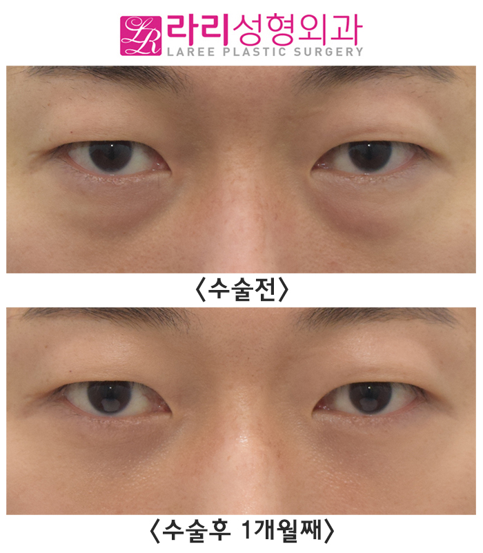 [라리성형외과] 간단해 보이지만 그렇지 않은 눈밑지방재배치수술 전후사진 관련 이미지 4