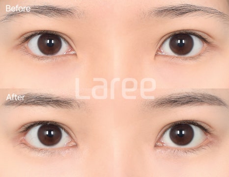 [LaLi Plastic Surgery] Outer Canthus Lowering Surgery, If It’s a Revision Surgery, It Must Be Done at a Place That Does It Well. image 5