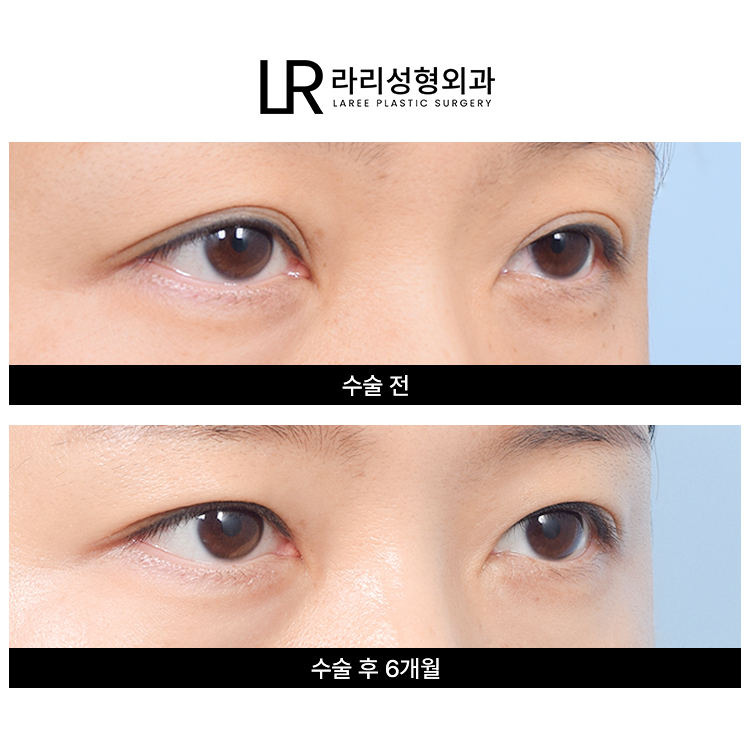[라리성형외과] 흐릿한 눈, 소세지 쌍꺼풀 인라인 속쌍으로 깔끔하게 관련 이미지 5