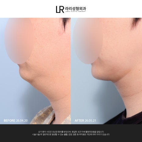 [라리성형외과] 이중턱 지방 흡입만으로는 아쉬운 얼굴 라인, 이중턱 근육 묶기도 같이 하면 효과가 두 배! 관련 이미지 8