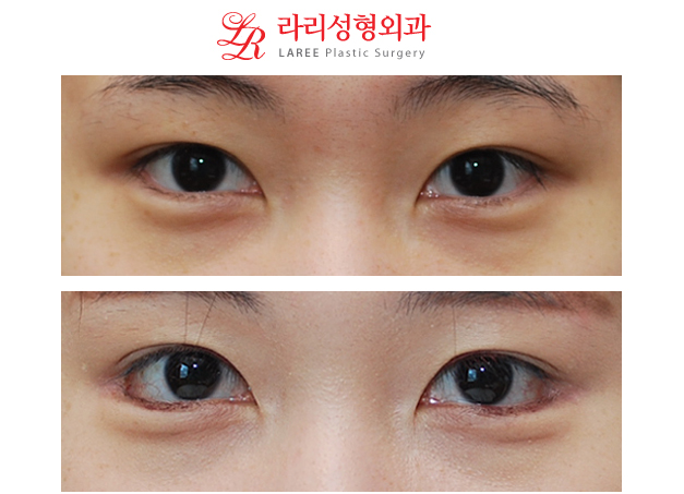 왕눈이성형 눈꼬리내리기뒤트임 전후사진 ※ 관련 이미지 1