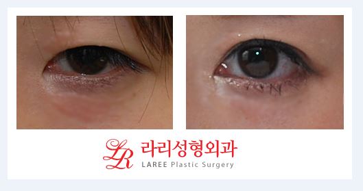 ※What Is the Wise Choice for Double Eyelid Revision Surgery?※ image 1
