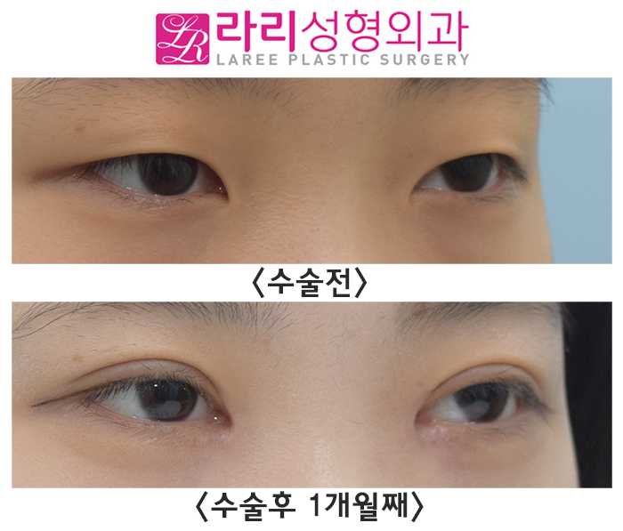 [라리성형외과] 쌍꺼풀 만드는 절개눈매교정과 앞트임수술 전후 관련 이미지 2