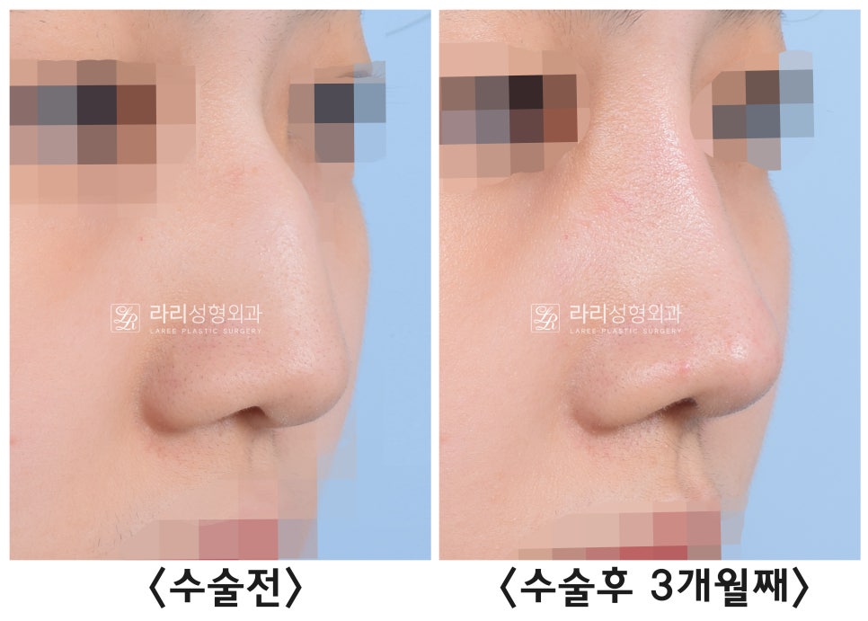 [라리성형외과] 절골을 포함한 매부리코 교정 수술(비순각 교정) 관련 이미지 5