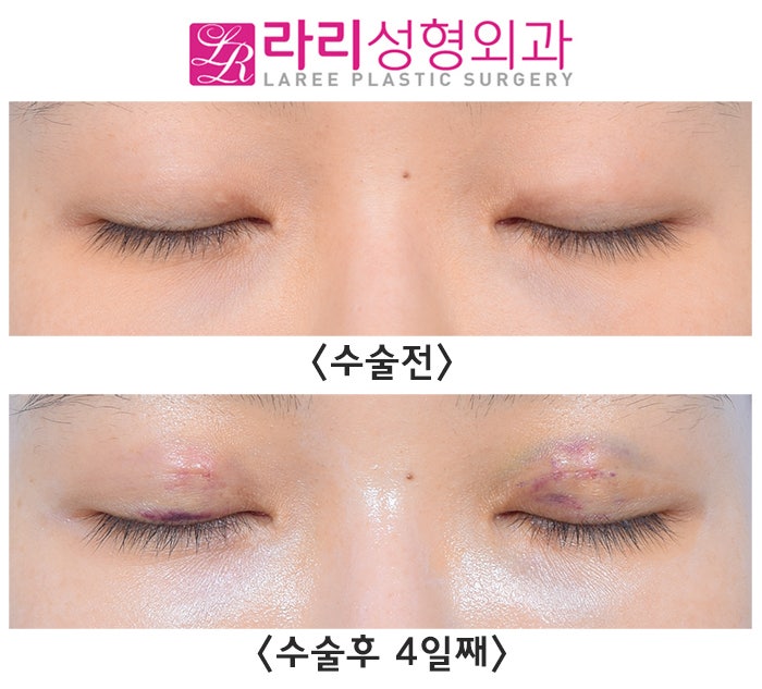 [Lari Plastic Surgery] Correcting Uneven Eyes with Non-Incisional Revision Surgery image 4