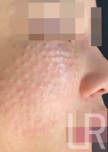 [Lari Plastic Surgery] Rejuran Treatments That Help Strengthen Your Skin’s Natural Ability to Become Healthy Begin at Lari Plastic Surgery. image 3