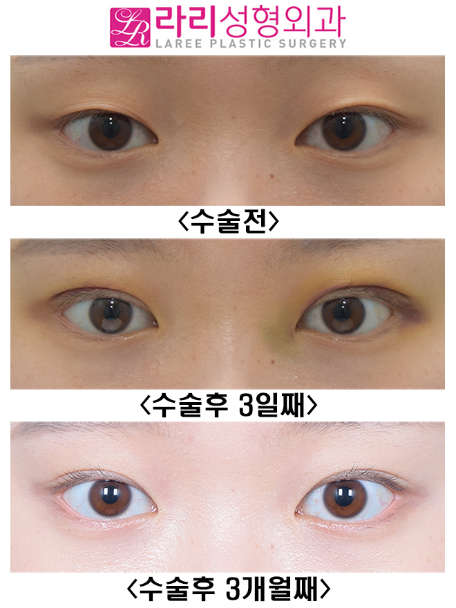 [라리성형외과] 흉터 없이 말끔한 매몰 쌍수 어때요? 관련 이미지 1