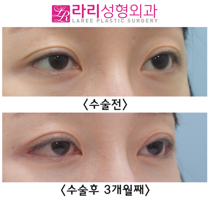 [라리성형외과] 수술 직후부터 흉터까지 뒤트임재수술 후 경과와 증상들 알아보기. 관련 이미지 3