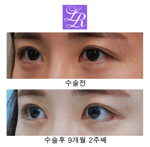 Changing Eyelid Crease Shape with Double Eyelid Reversal Surgery image 2