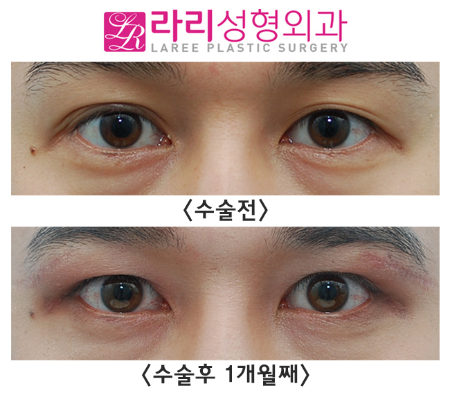 [라리성형외과] 겹쌍꺼풀 처진 눈 쌍꺼풀없애기, 그리고 눈썹하거상수술 전후 효과 관련 이미지 1