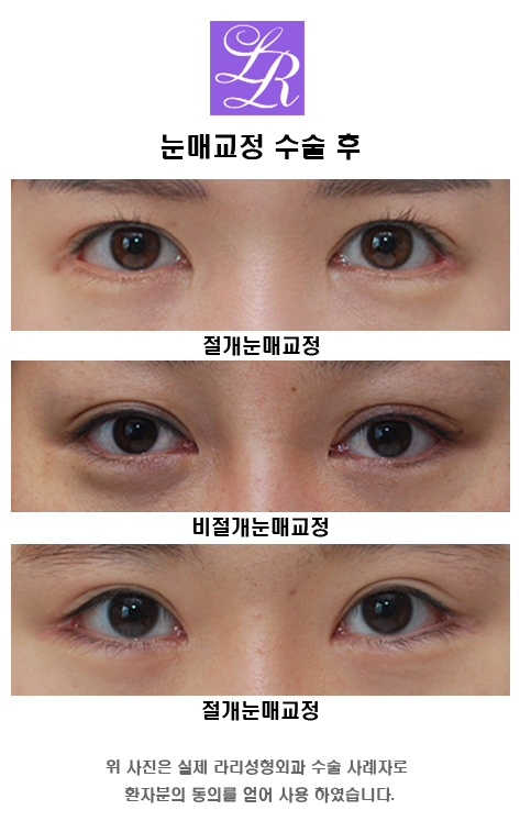 뒤트임 눈매교정 함께 관련 이미지 3