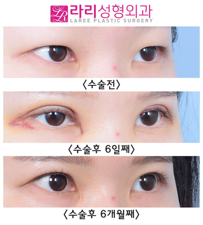 [Lari Plastic Surgery] Incisional Eye Correction Surgery for a Hidden Double Eyelid in a Monolid: Swelling Period Before and After (+Selfie) image 5