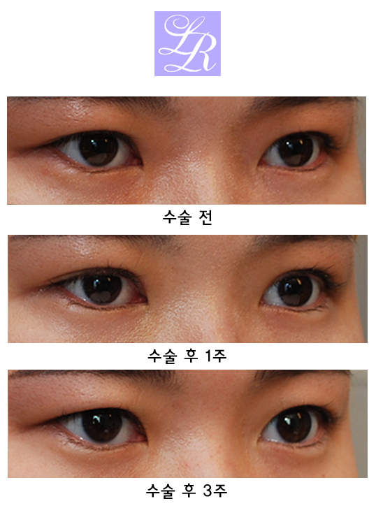 비절개눈매교정 - 미세 눈 비대칭 짝짝이 교정 관련 이미지 7