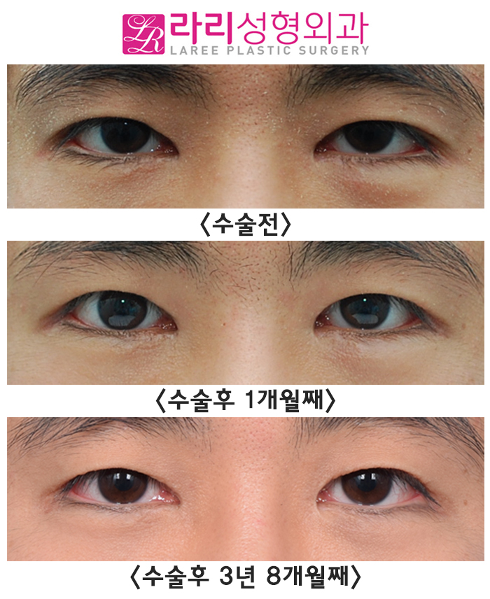 [Rari Plastic Surgery] Before-and-After Photos of Natural Epicanthoplasty Revision Surgery Without Eye Shrinkage or Recurrence image 1