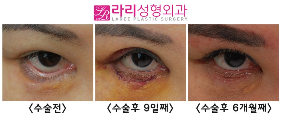 [Rari Plastic Surgery] Eyelid Ectropion Correction Surgery Methods According to Eye Condition image 2