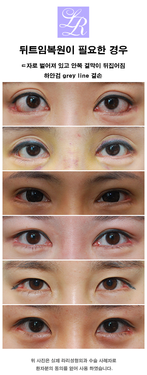 Lateral Canthoplasty Restoration - When Is the Reconstruction Timing Before and After Revision Surgery? image 2