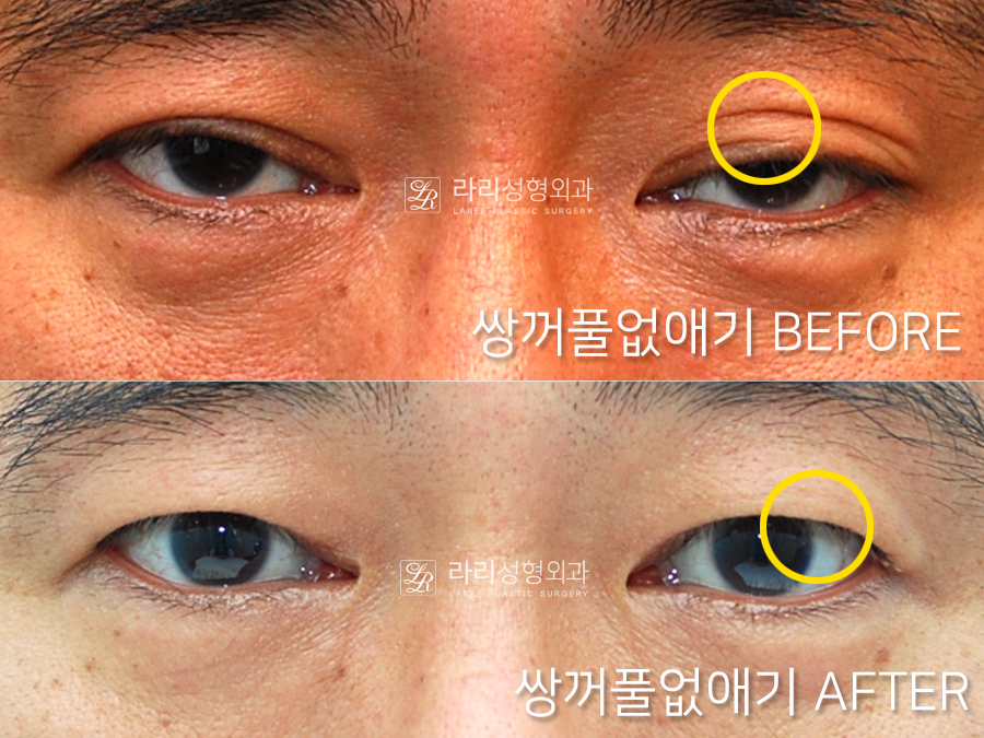 [라리성형외과] 쌍꺼풀없애기 무쌍수술, 자연스러운 변화와 눈 깜빡임을 확인하세요. 관련 이미지 2