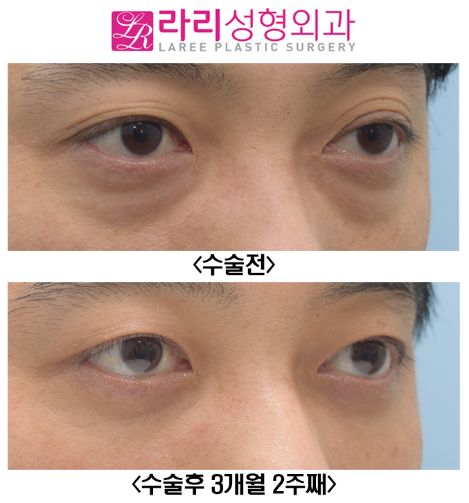 [라리성형외과] 피곤해보이는 여러겹 자연쌍꺼풀없애기와 눈밑지방재배치 수술 전후 관련 이미지 3