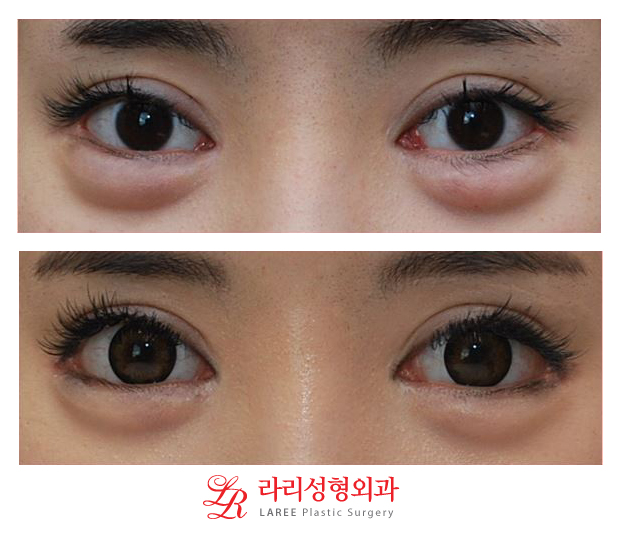 뒤트임/뒷트임 사진 후기 정보☆ 관련 이미지 1