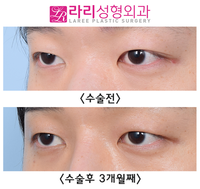 [라리성형외과] 고르지 못한 쌍꺼풀 라인의 개선을 위한 쌍꺼풀 지우는 수술 전후 사진 관련 이미지 4
