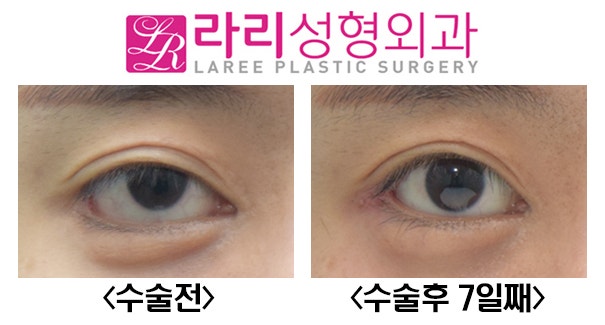 [라리성형외과] 다양한 뒤트임복원수술 전후사진 관련 이미지 6