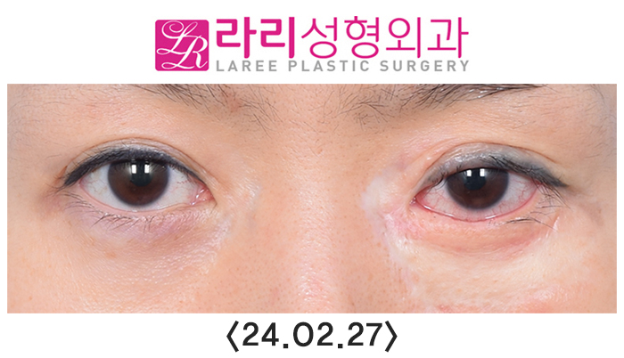 [라리성형외과] 연골이식으로 하안검외반의 일종인 삼백안 교정하기 관련 이미지 2