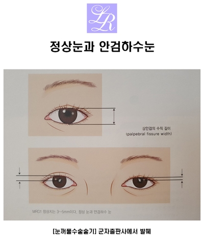 Is eyelid drooping a symptom of ptosis? image 2
