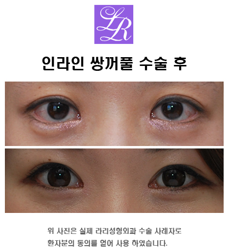쌍꺼풀만들기 - 쌍액, 쌍테, 쌍수 뭘 해야하죠? 관련 이미지 4