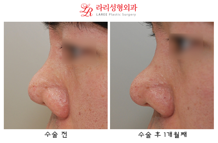 Correction of Upturned Nose and Contracted Nose, Revision Rhinoplasty Using Autologous Tissue (feat. Ear Cartilage) image 2