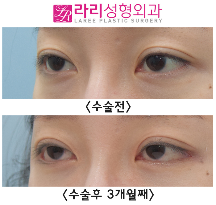 [라리성형외과] 수술 직후부터 흉터까지 뒤트임재수술 후 경과와 증상들 알아보기. 관련 이미지 2