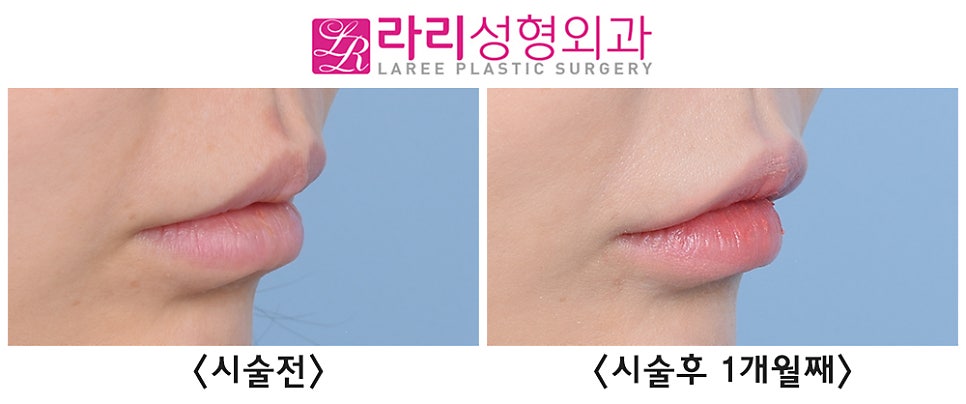 [라리성형외과] 1cc의 변화, 웃는 입모양 만드는 입꼬리 필러 전후 사진 관련 이미지 3