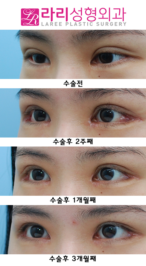 눈재수술  원인을 찾아서 ! (쌍재, 앞재, 뒤재로 해결) 관련 이미지 3