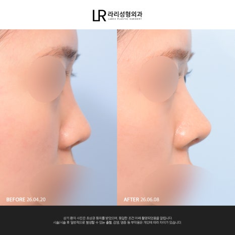 [Lari Plastic Surgery] If You Are Considering Nose Surgery, Do Not Get Nose Thread-Lifting Procedures Like Misko / Hiko!! image 16