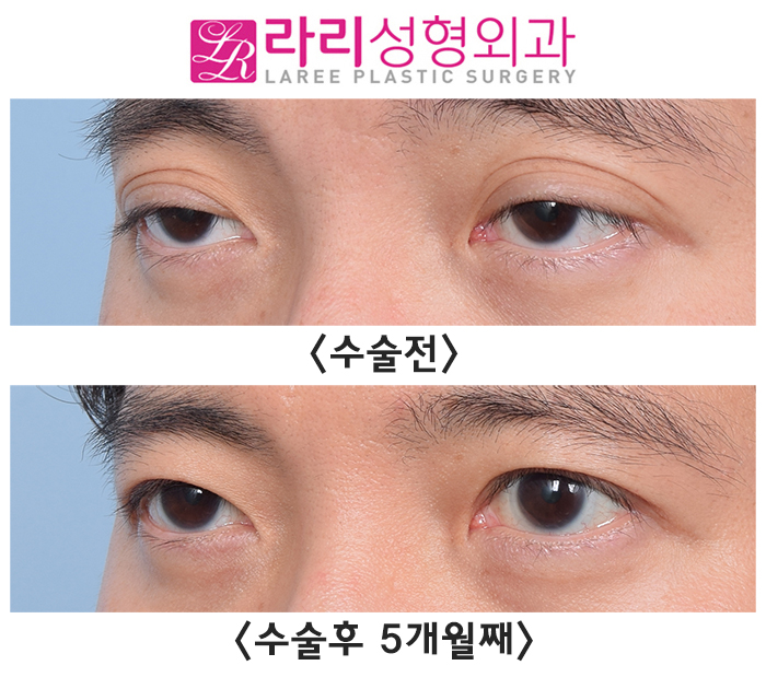 [라리성형외과] 쌍꺼풀없애기와 눈매교정수술의 콜라보 (+ 눈도 잘 감겨요) 관련 이미지 2