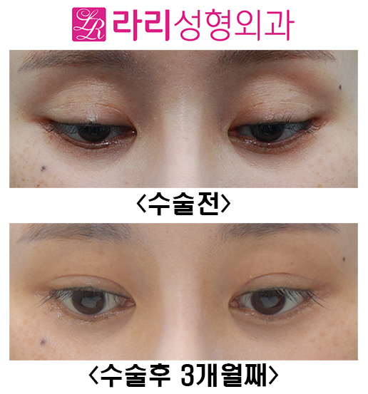 [라리성형외과] 쌍꺼풀재수술 눈두덩이 sunken 교정 관련 이미지 4