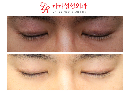 남자 쌍꺼풀재수술 (쌍꺼풀푸는수술/쌍꺼풀없애는수술) ☆ 관련 이미지 2