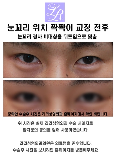 Are You Curious About Canthoplasty for Men? image 4