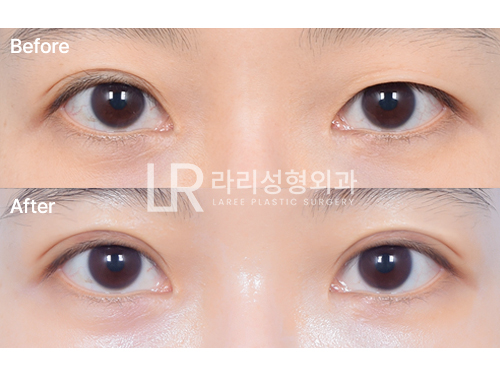 [라리성형외과] 비절개 재수술로 짝짝이 눈 교정하기 관련 이미지 6