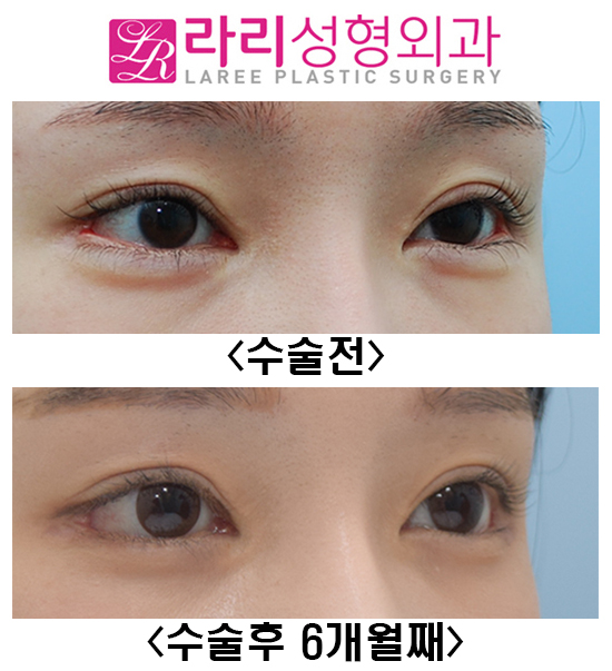 [Rari Plastic Surgery] Canthoplasty Revision Surgery, Entropion Surgery, Under-Eye Fat Repositioning Before-and-After Photos image 2