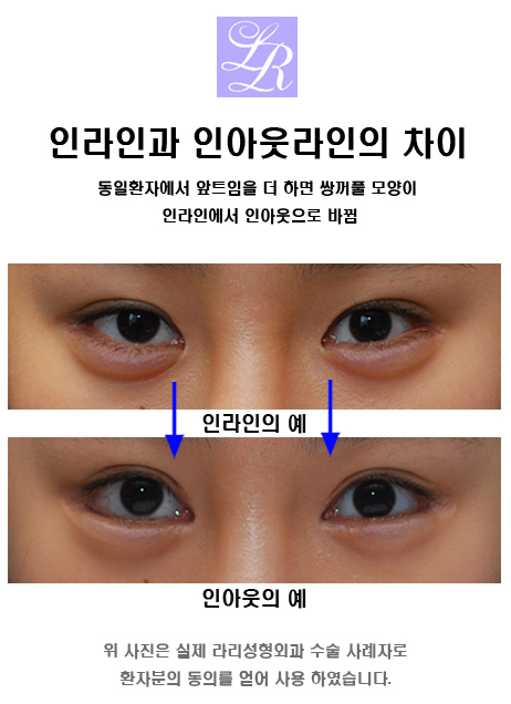 Comparison of In-Out Double Eyelid Shapes image 3