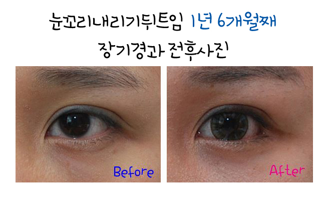 눈꼬리내리기뒤트임/뒷트임 장기경과 후기 효과가 확실하네~☆ 관련 이미지 3