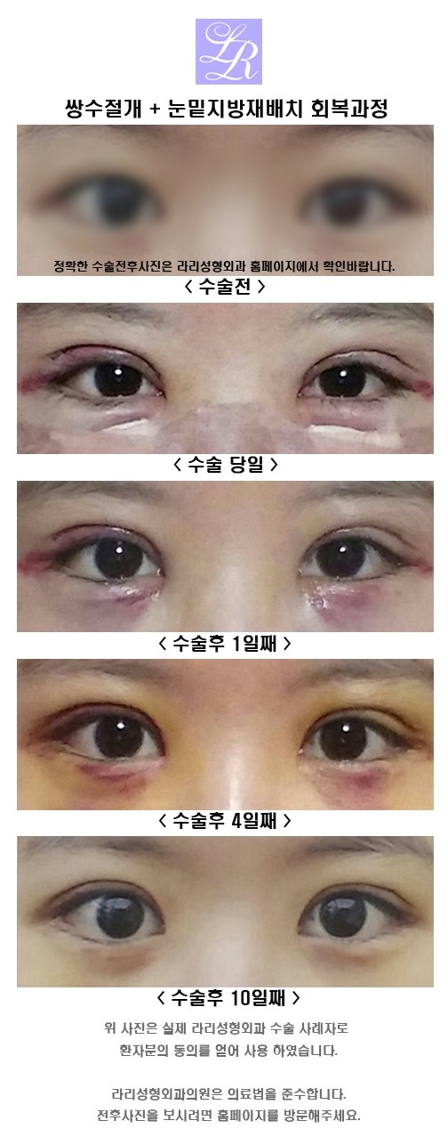 Types of Eye Surgery: Learn About Before-and-After Information image 5