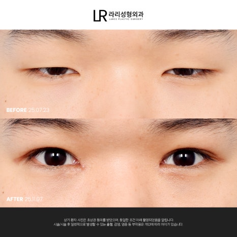 [라리성형외과] 눈 (재) 수술은 라리성형외과가 관련 이미지 3