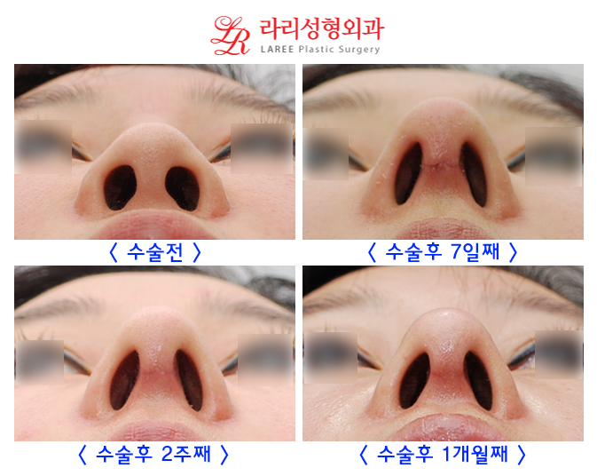 Rhinoplasty Review: Tip Plasty + Cat Surgery Before and After image 2