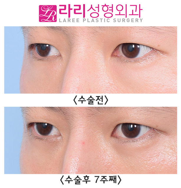 [Lari Plastic Surgery] Check for Undetected Under-Eye Fat and Solve It with Under-Eye Fat Repositioning. image 4